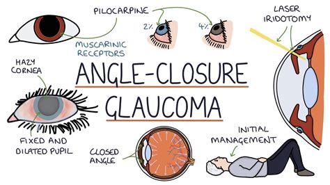Dealing with Acute Angle-Closure Glaucoma? Find Relief with an Experienced Optometrist